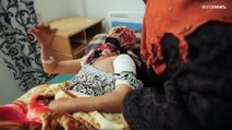 يونيسف: ملايين الأطفال في اليمن معرضون لسوء التغذية بسبب نقص التمويل