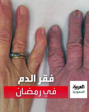 اختصاصية توجه نصائح لكيفية تعامل مرضى فقر الدم مع الصيام