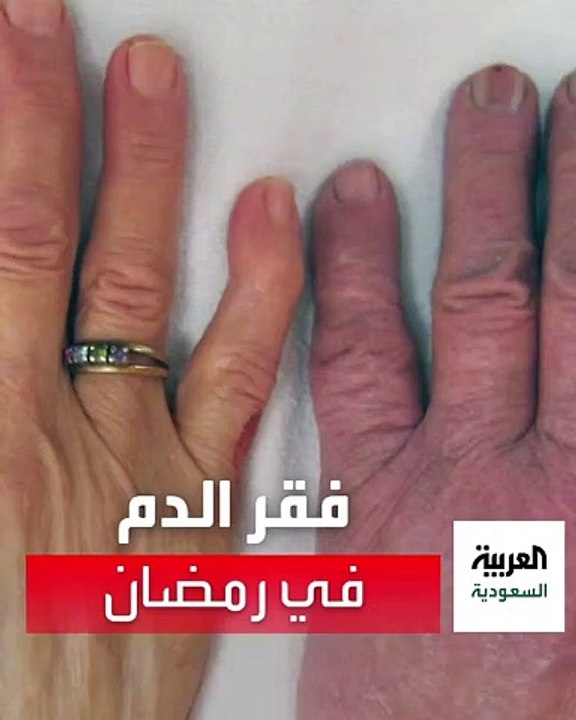 نصائح ضرورية لمرضى فقر الدم لصيام صحي في رمضان