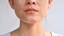 3 Types of Acne Scars—and the Best Treatments for Each