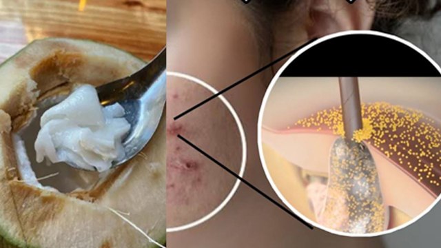 Face पर नारियल की मलाई लगाने से क्या होता है | Nariyal Ki Malai Chehre Par Lagane Ke Fayde | Boldsky