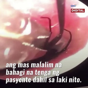 Dambuhalang langaw, nakuha sa tenga ng isang lalaki | GMA News Feed