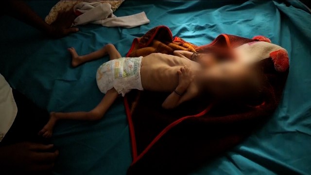 اليمن.. تجربة عيادة تعمل على إنقاذ أطفال مصابين بسوء التغذية