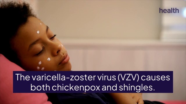 Chickenpox vs. Shingles: Causes, Symptoms, and Treatments