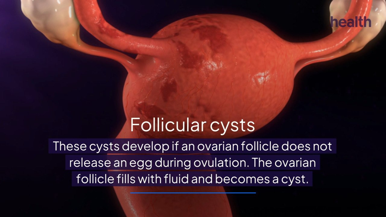 Signs and Symptoms of Ovarian Cysts