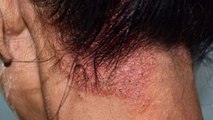 Eczema Touch करने से Spread होता है या नहीं | Eczema Kaise Hota Hai | Boldsky
