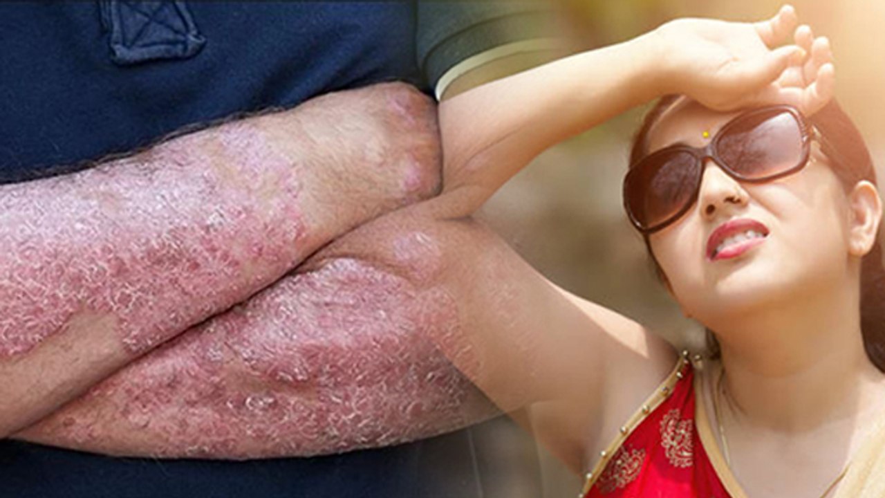 Sun Poisoning क्या होता है ? Sun Poisoning Symp...