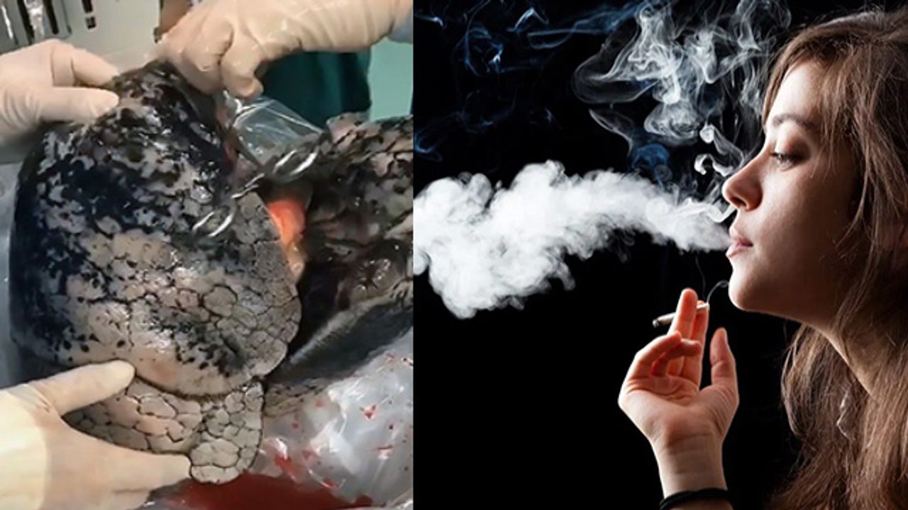Bullous Disease क्या है जिससे खोखले हो जाते है...