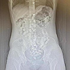 İRANLI 2 KADININ MİDELERİNDEN 693,3 GRAM AFYON SAKIZI ÇIKTI