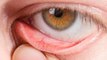 Dry Eyes Home Remedy | Dry Eye Treatment At Home | आंखों का सूखापन कैसे दूर करें | Boldsky