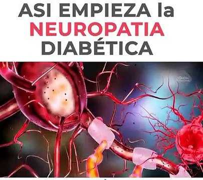 Asi Empieza La Neuropatia Diabetica