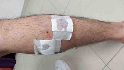 Mersin'de sokak köpekleri belediye çalışanına saldırıp ısırdı