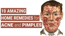 10 Amazing Home Remedies for Acne and Pimples