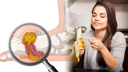 Uric Acid Me Kela Kha Sakte Hain Ki Nahi | यूरिक एसिड में केला खा सकते है कि नहीं | Boldsky