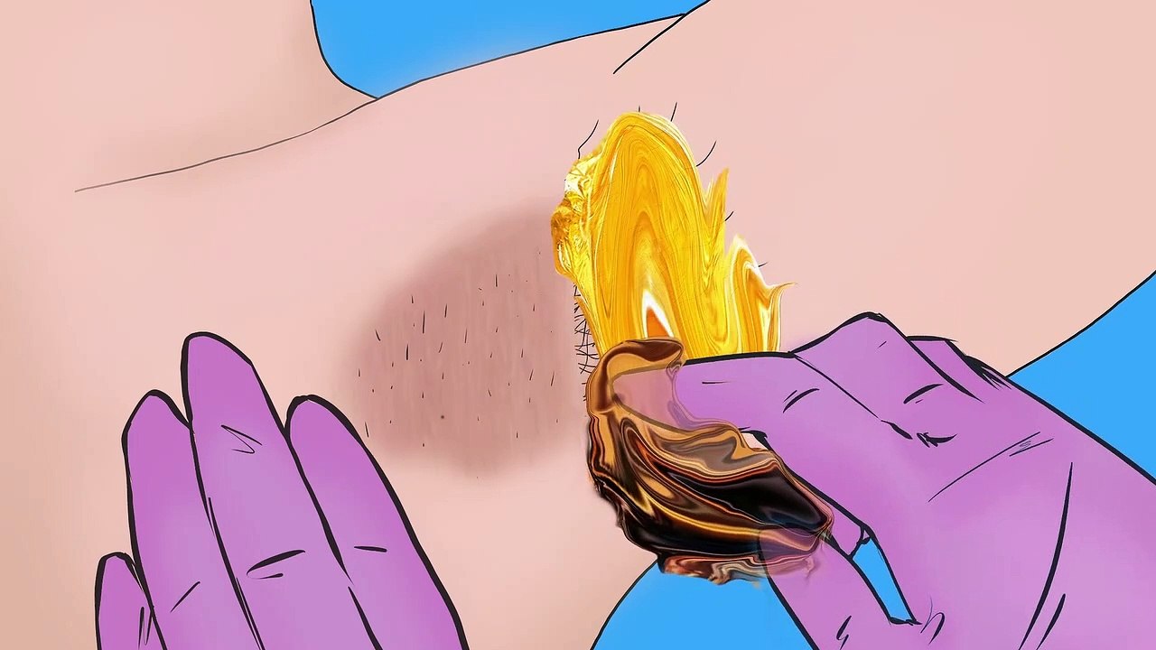 ASMR - INGROWN HAIR REMOVAL SUGAR WAXING | 겨드랑이 케어 Waxing & Armpit Care  Aniamtion