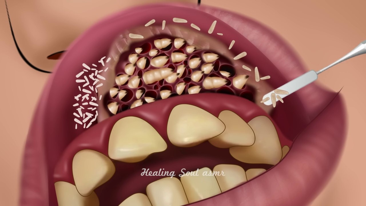 ASMR Remove botfly maggots found inside mountaineer's mouth ｜ Dental care animation