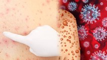 Chicken Pox कैसे Spread होता है , क्या है Symptoms और Reason , कैसे करें Treatment |Boldsky