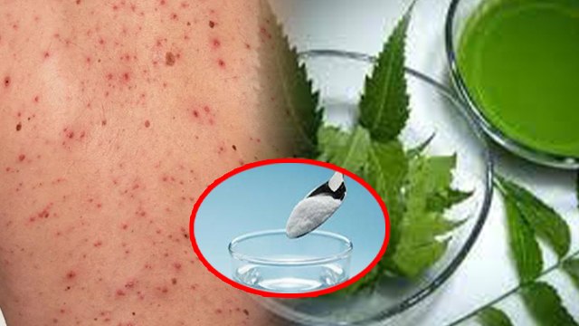चिकेनपॉक्स में खुजली होने पर क्या करें ? Chickenpox Me Khujli Hone Par Kya Kare ? । Boldsky