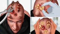 ASMR Popping pustules on head spike implant animation | Body modification