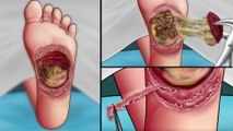 ASMR Remove maggot from hole diabetic foot ulcer | Treatment animation
