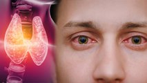 Thyroid Eye Disease Kya Hai । Thyroid Eye Disease Reason । Boldsky