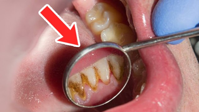 Tartar Kya Hai | Tartar Plaque Removal | Tartar Plaque Difference | Tartar kaise hataye | Boldsky