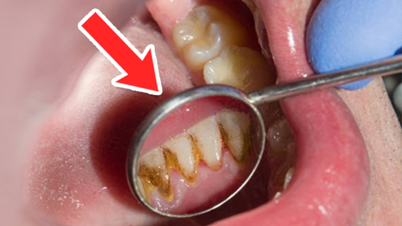 Tartar Kya Hai | Tartar Plaque Removal | Tartar Plaque Difference | Tartar kaise hataye | Boldsky