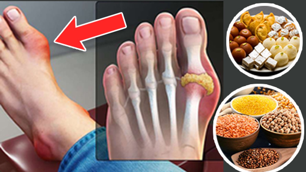 रात में यूरिक एसिड क्या खाने से बढ़ता है | Night Me Uric Acid Kya Khane Se Badhta Hai | Boldsky