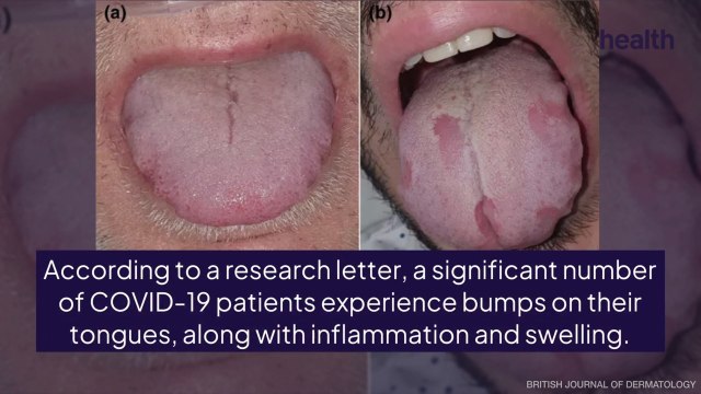 COVID Tongue: How a Swollen Tongue Could Indicate COVID-19