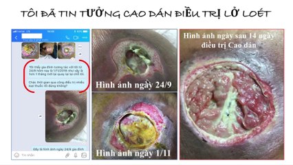Tôi đã tin tưởng Cao dán điều trị lở loét | Thuốc trị lở loét ngoài da