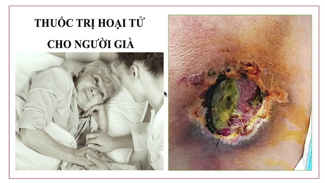 Thuốc trị hoại tử cho người già | Người già nằm lâu bị lở loét | Thuốc trị lở loét tại nhà không gây đau xót