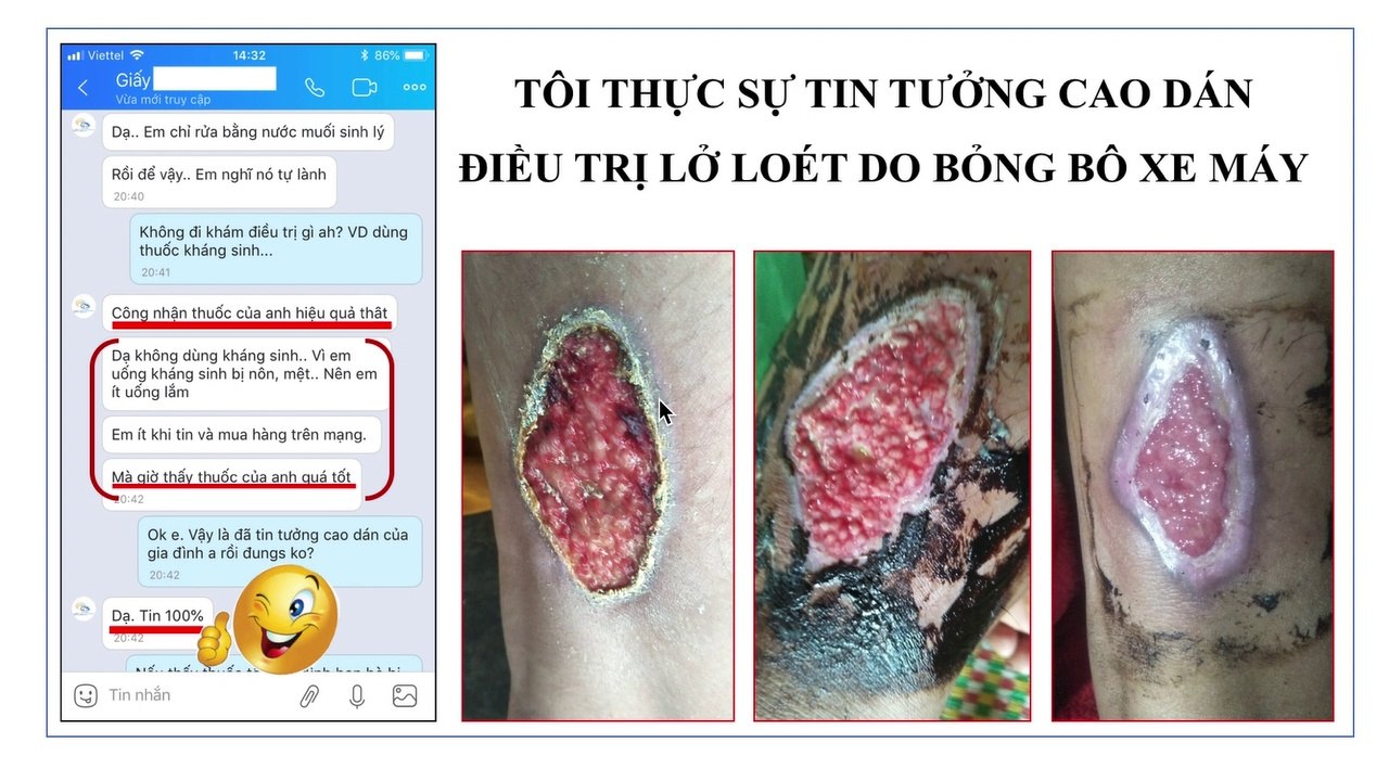 Thuốc điều trị Bỏng bô xe máy |  Bỏng bô xe máy bao lâu thì khỏi | Bỏng bô xe máy bị phồng.