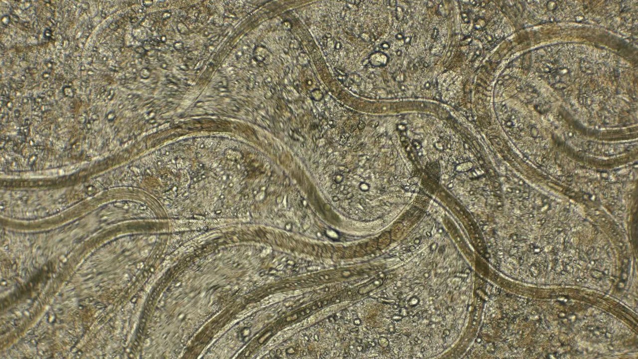 Doctors find this inside woman's skin and brain after she suffered from severe headaches