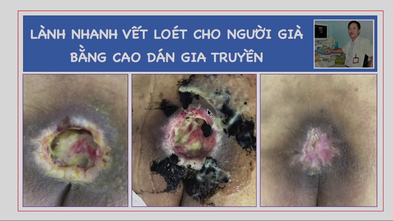 Lành nhanh vết loét người già | Người già bị lở loét ngoài da | Loét da ở người già có khó điều trị không