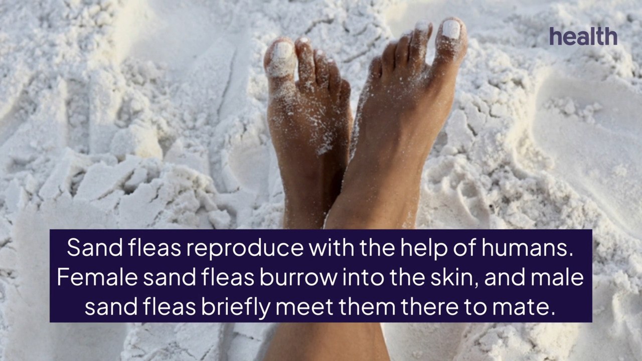 What Are Sand Fleas and How Can Their Bite Affect You