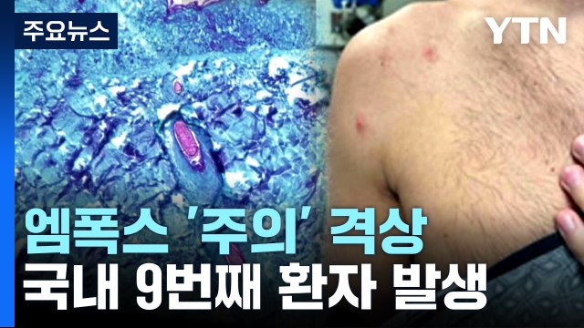엠폭스 국내 9번째 환자 추가...위기경보 '주의' 격상 / YTN
