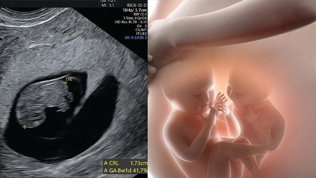 Vanishing Twin Syndrome In Hindi, Symptoms Reason क्या है | Boldsky