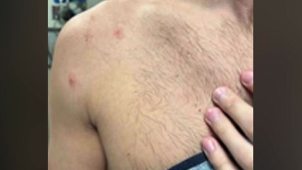 이달 들어 지역감염 4명 발생...엠폭스 위기경보 '주의' 격상 / YTN