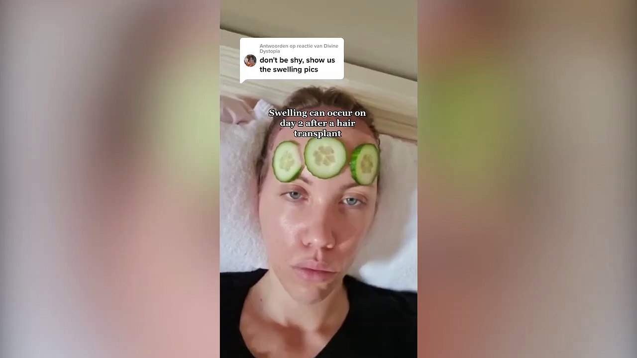 Woman who had hair transplant to cover "big forehead" urges others to ditch shame over the procedure
