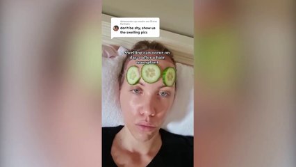 Woman who had hair transplant to cover "big forehead" urges others to ditch shame over the procedure