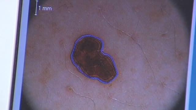 Moderna anuncia para 2030 una vacuna contra el cáncer de piel