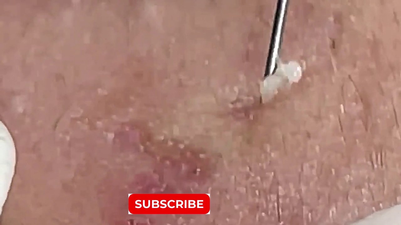 Blackheads removal | blackheads new this week 2023