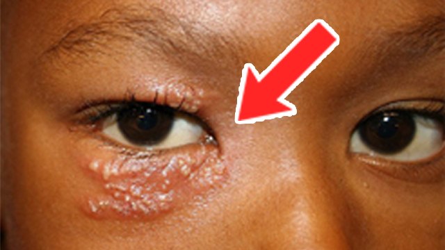 Eye Shingles क्या है | आँखों के आस पास दाद होना इस गंभीर बीमारी का लक्षण | Boldsky