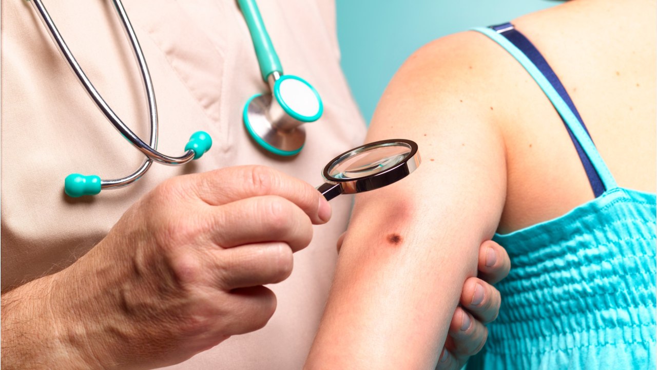 These are the often overlooked signs of skin cancer