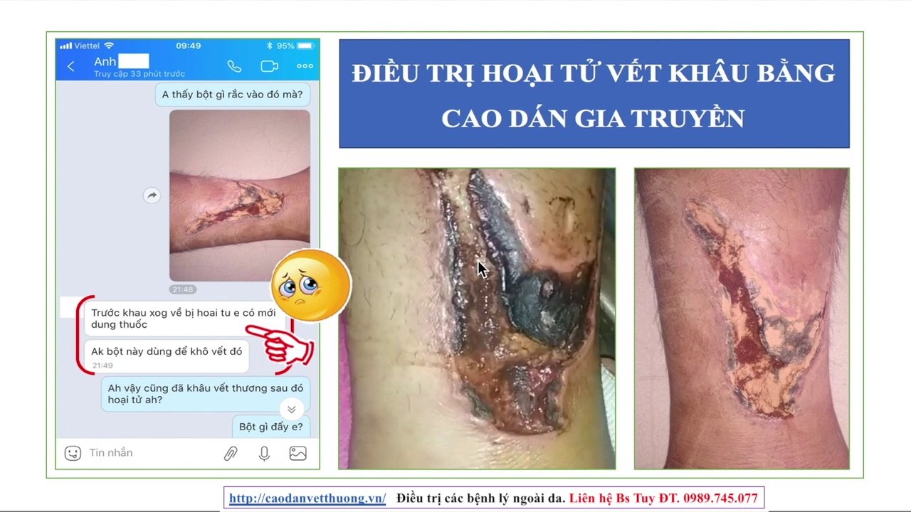 Điều trị nhiễm trùng vết mổ |  Nhiễm trùng vết mổ | Vết mổ chảy dịch bốc mùi hôi thối