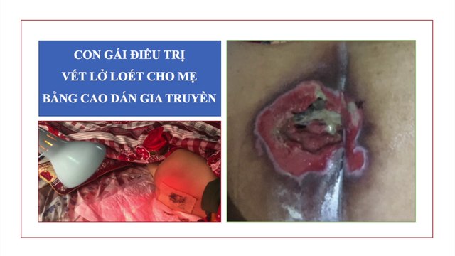 Con gái điều trị lở loét vùng cùng cụt cho mẹ bằng Cao dán gia truyền | Lở loét cùng cụt | Thuốc trị lở loét da