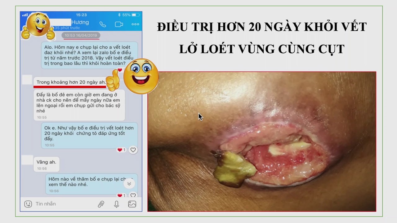 Lành nhanh vết lở loét sau 20 ngày điều trị | Miếng dán trị lở loét ngoài da | Thuốc điều trị loét da vùng cùng cụt