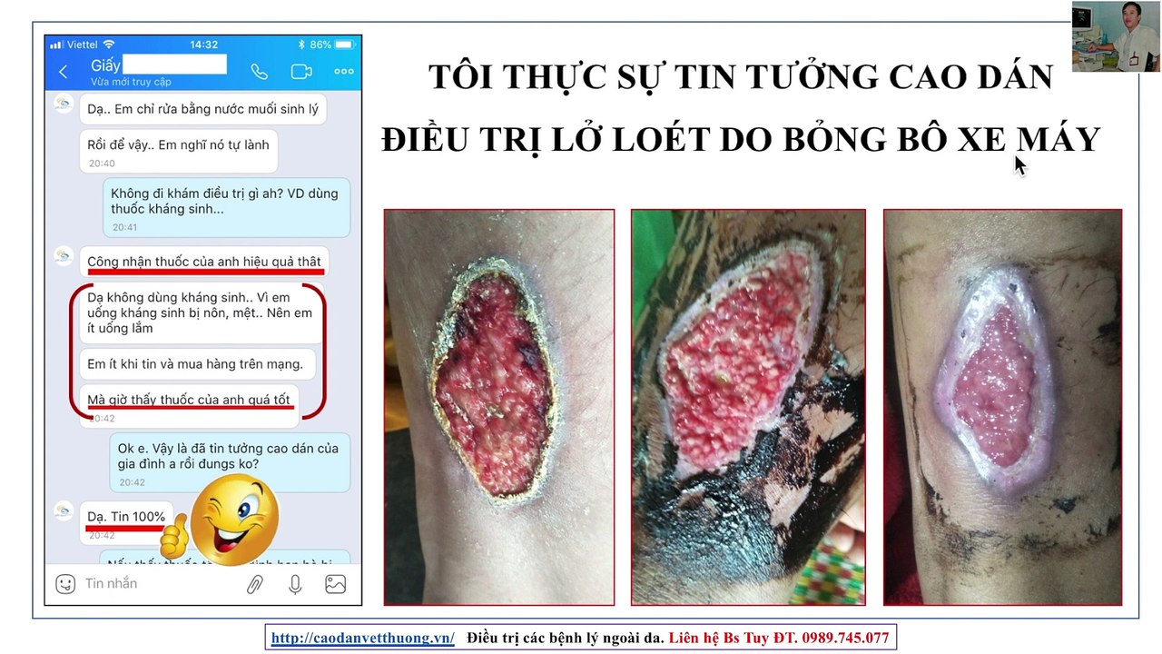 Tôi thực sự tin tưởng Cao dán điều trị lở loét do Bỏng bô xe máy |  Lở loét do Bỏng bô xe máy