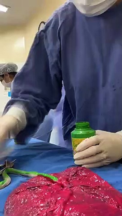 Vídeo: Veja como é feito o enquadramento de placenta