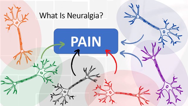 What is neuralgia? Symptoms, causes and treatment of the disease